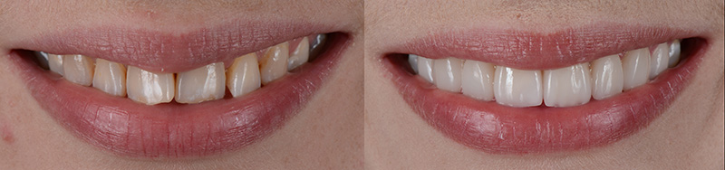 Before and after photo of a smile makeover with crowns and veneers replacing worn, discolored front teeth