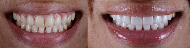 Before and after photo of porcelain veneers placed on the upper front teeth at Uptown Dentistry