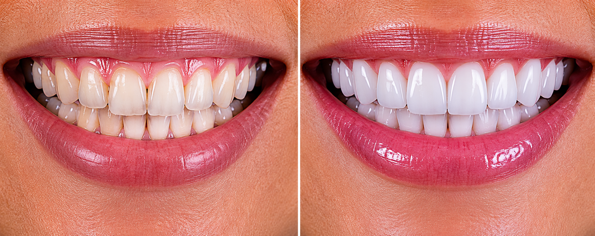 Teeth Whitening in Houston at Uptown Dentistry