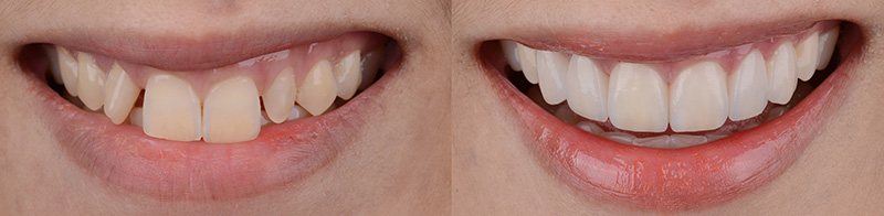 Before and after photo of cosmetic reshaping and whitening that closed gaps between the front teeth